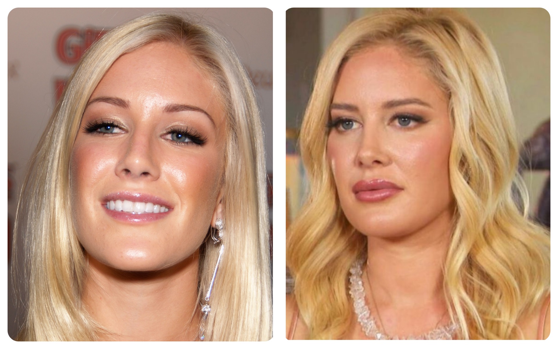 Heidi Montag – Ten Procedures in One Day