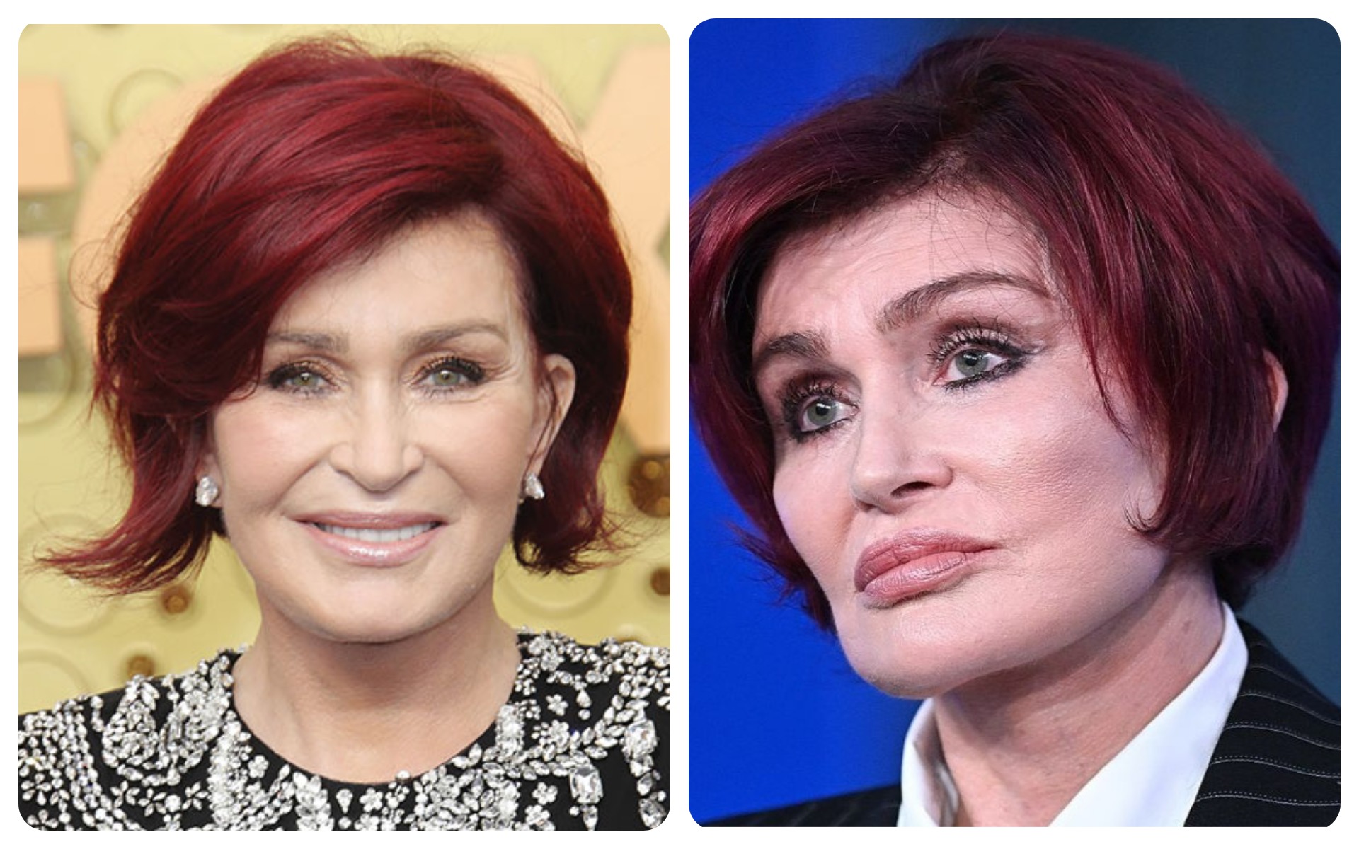 Sharon Osbourne – Facelift