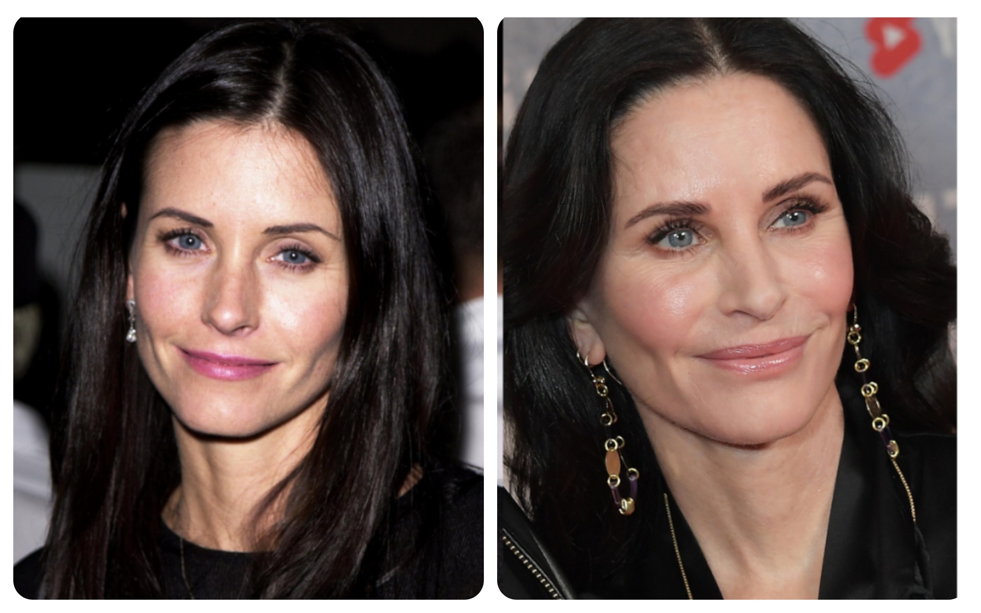 Courtney Cox – Filler & Botox