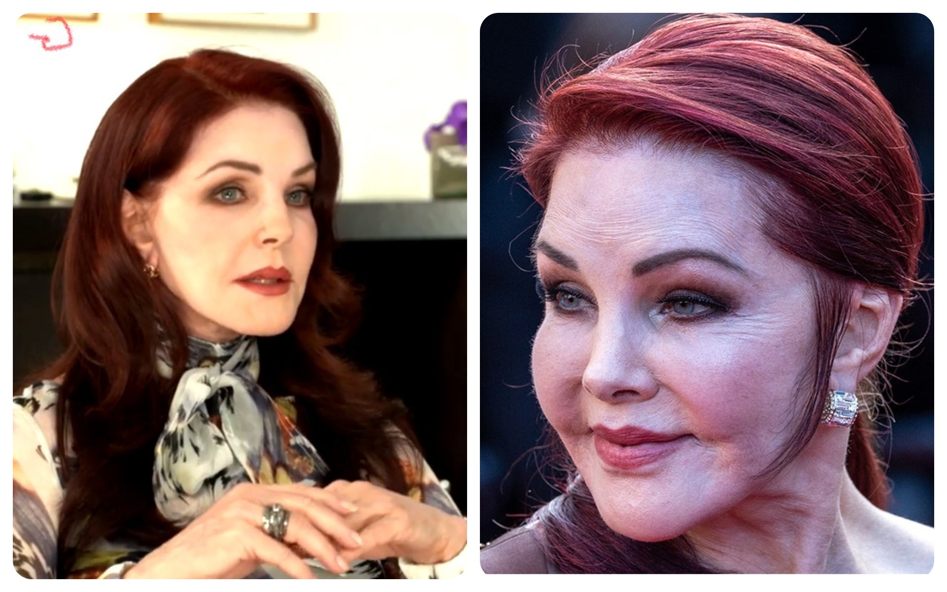 Priscilla Presley – Illegal Silicone Injections