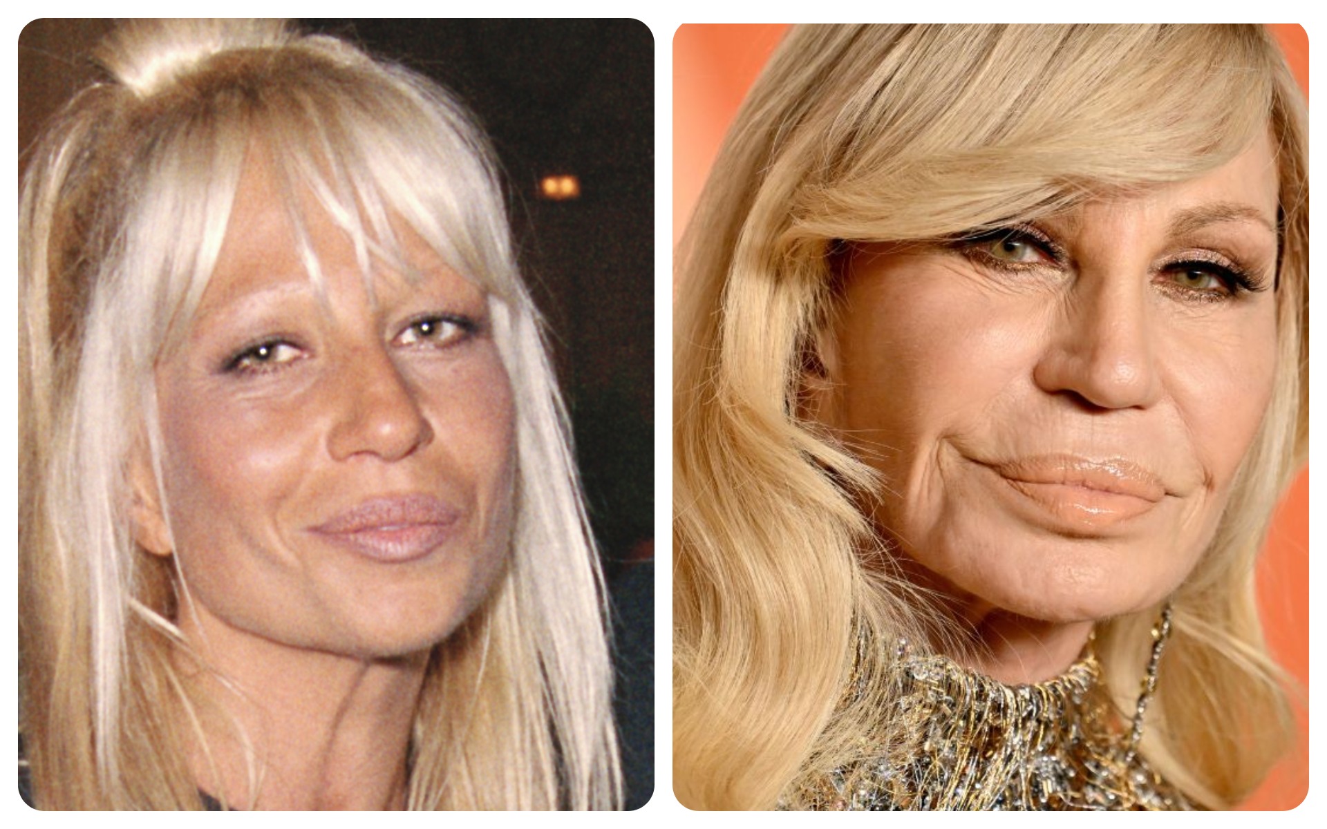 Donatella Versace – Facial Overfill
