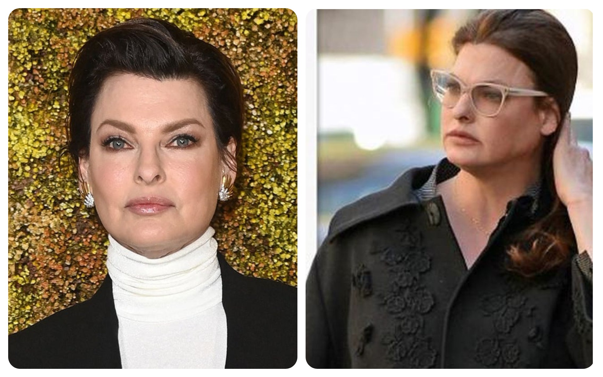 Linda Evangelista – CoolSculpting Disaster