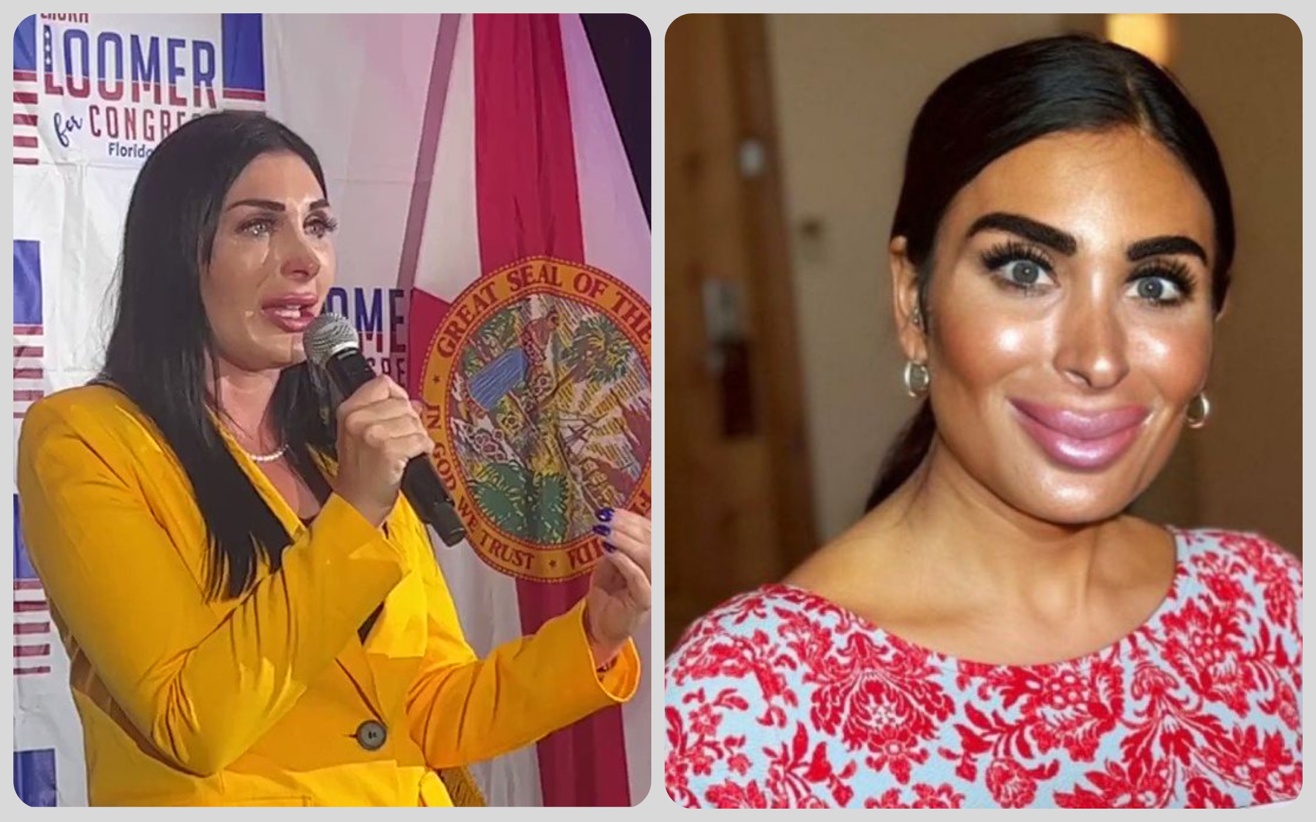 LAURA LOOMER'S PUFFY-FACED NEW PLASTIC SURGERY