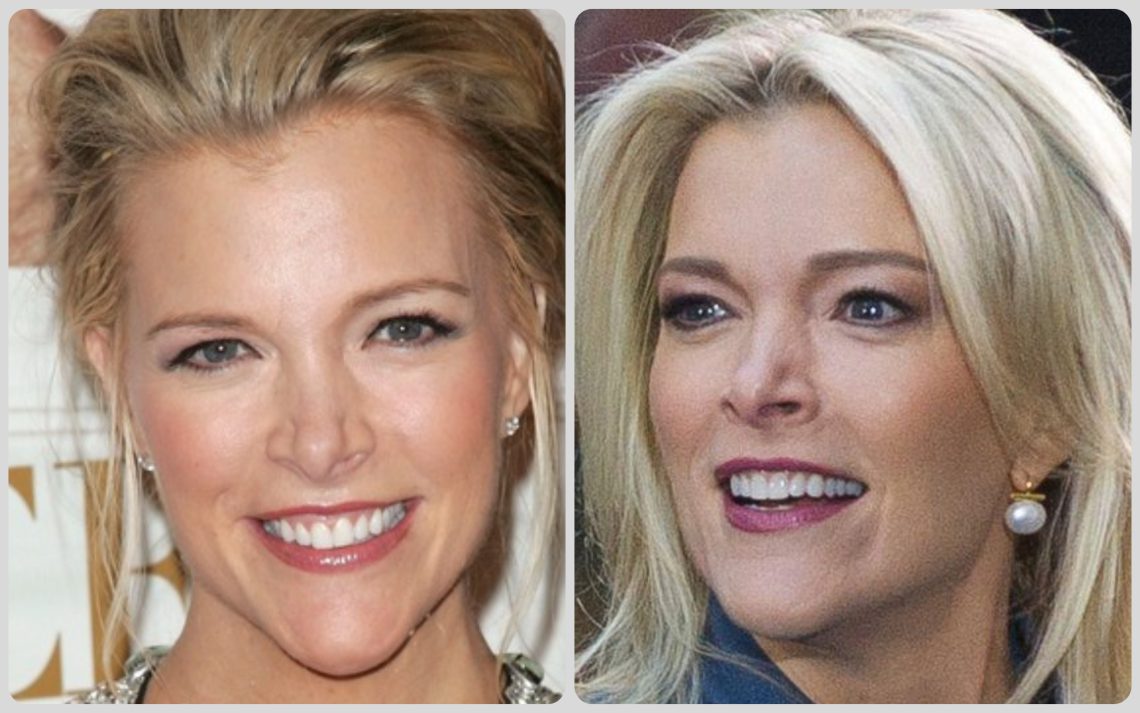 Megyn Kelly nose