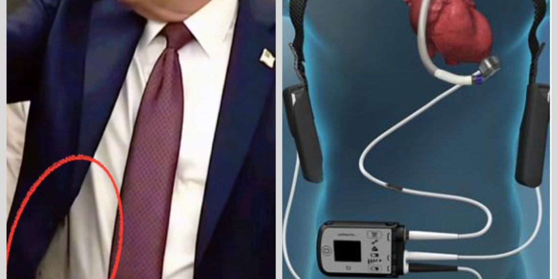 Trump might be wearing a ventricular assist device, also known as an LVAD