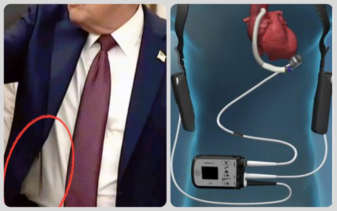 Trump might be wearing a ventricular assist device, also known as an LVAD