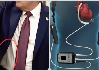 Trump might be wearing a ventricular assist device, also known as an LVAD