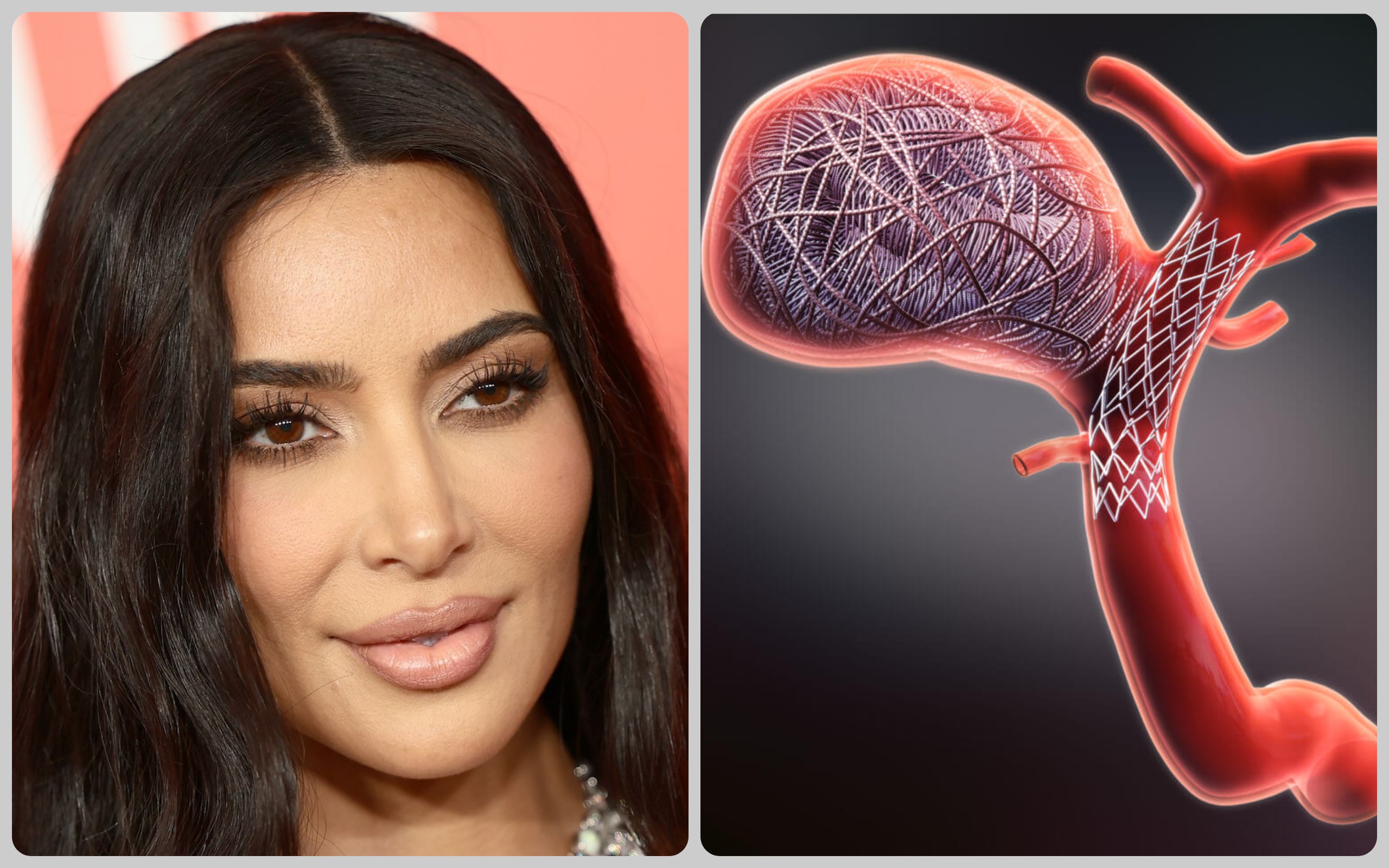 Kim Kardashian Brain Aneurysm